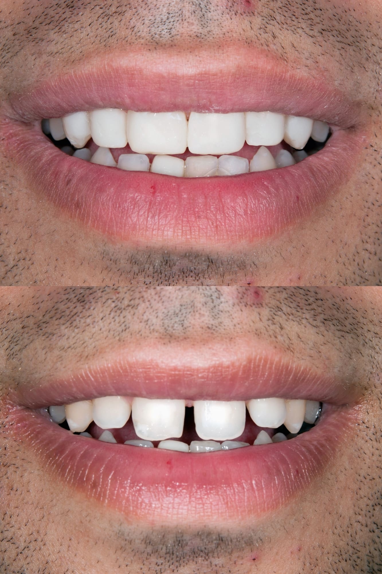 diseño de sonrisa nuevo ejemplo 1