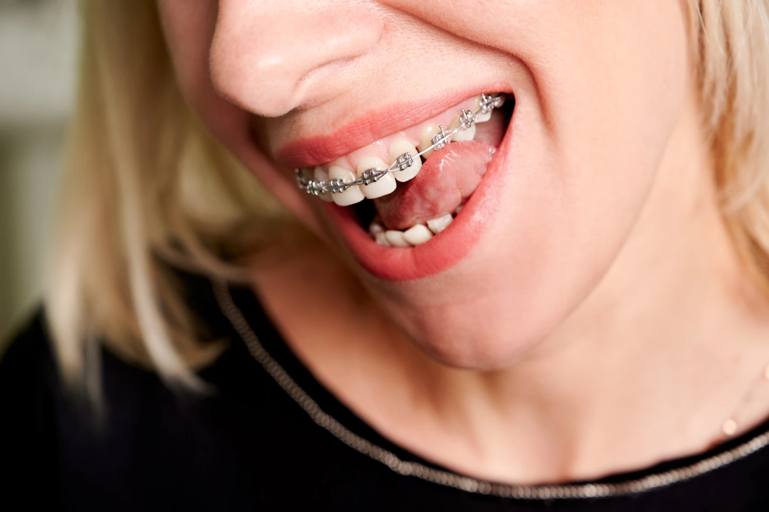 invisible vs brackets-1