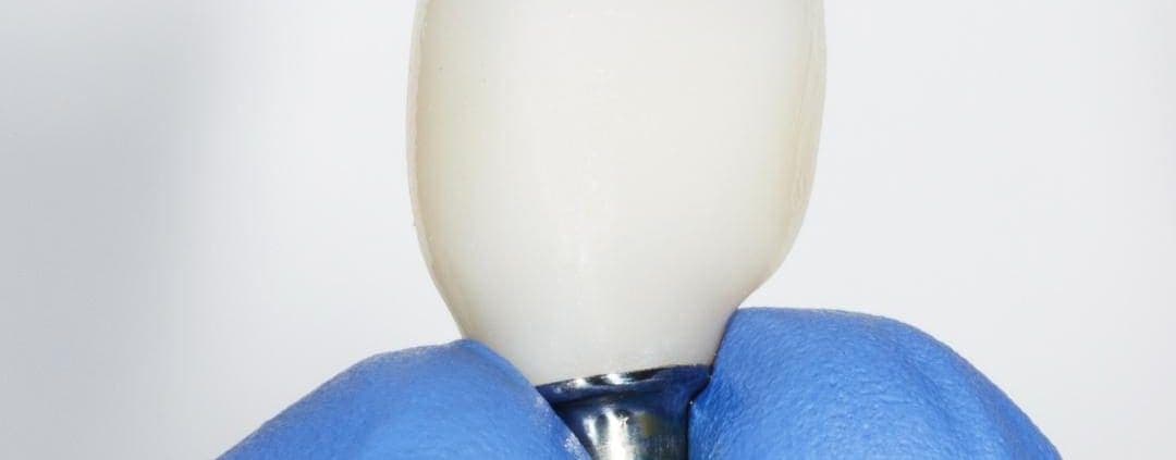 corona de zirconio