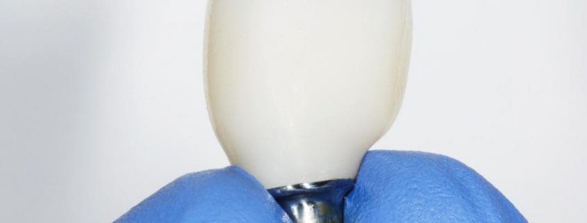 Coronas de Zirconio: Ventajas, características y precios 3 corona de zirconio