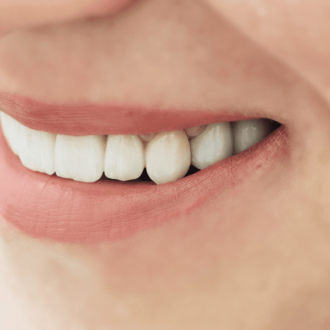 sonrisa con corona de zirconio sonrisa con corona de zirconio - coronas de zirconio