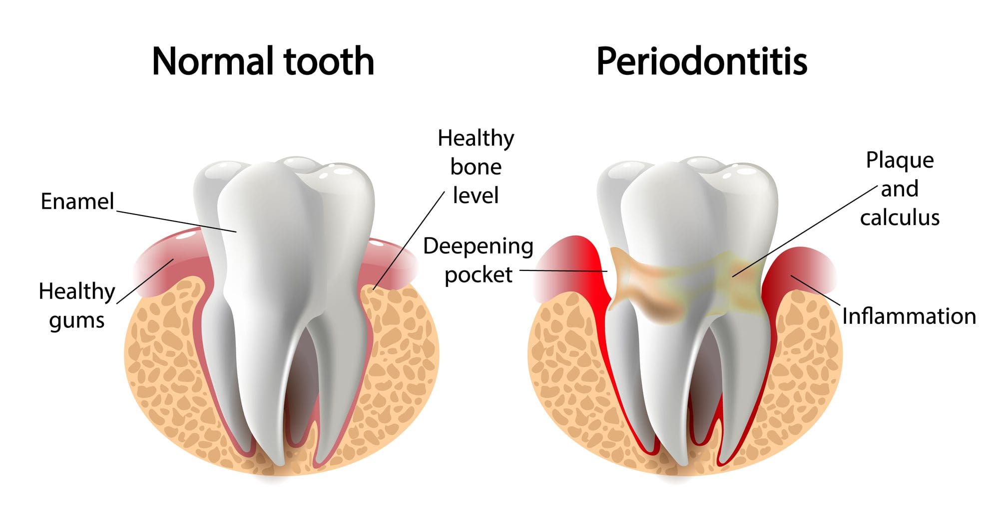 Vector imagen diente Enfermedad de periodontitis
