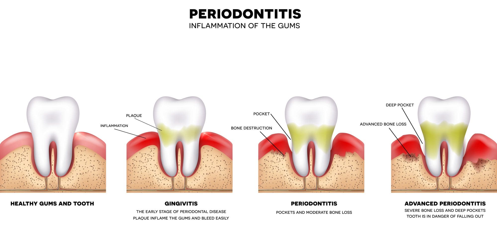 avances de la periodontitis