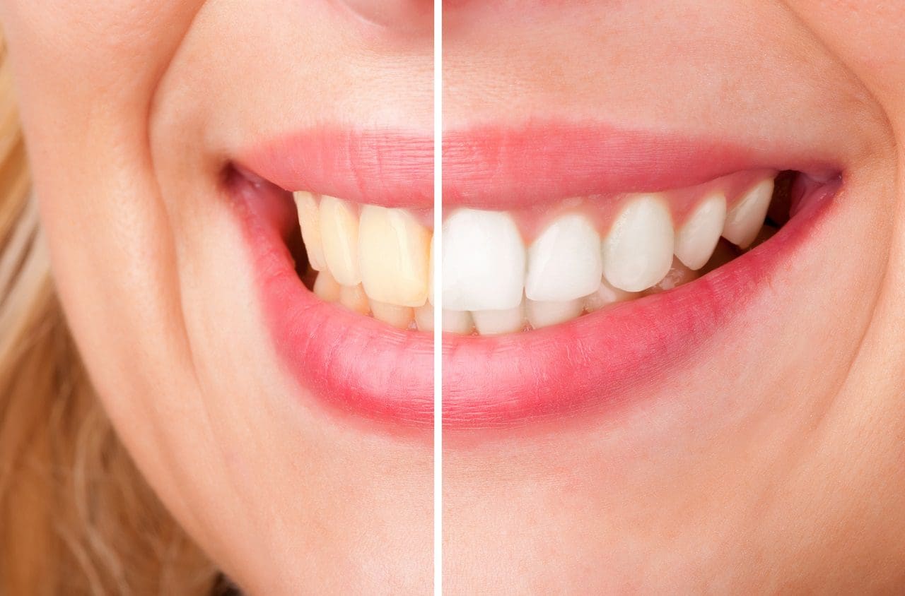 blanqueamiento dental antes y despues de una paciente