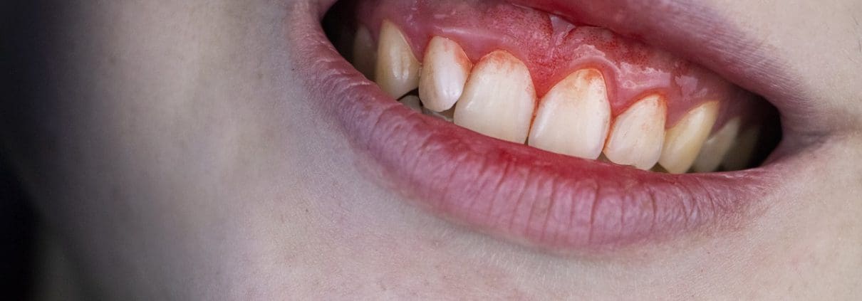 sangrado e inflamacion de las encias periodontitis