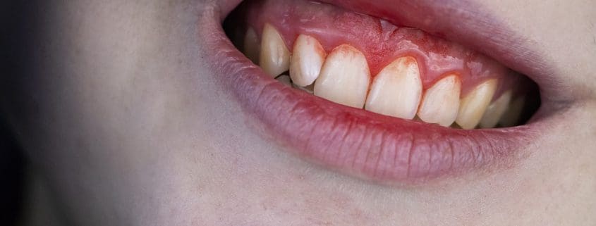 sangrado e inflamacion de las encias periodontitis
