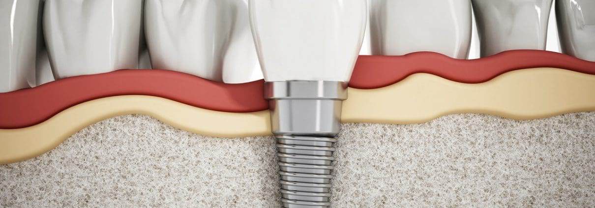 Implantes dentales - Intervención en Cadena SER Alicante 1 detalle del implante dental - implantes dentales