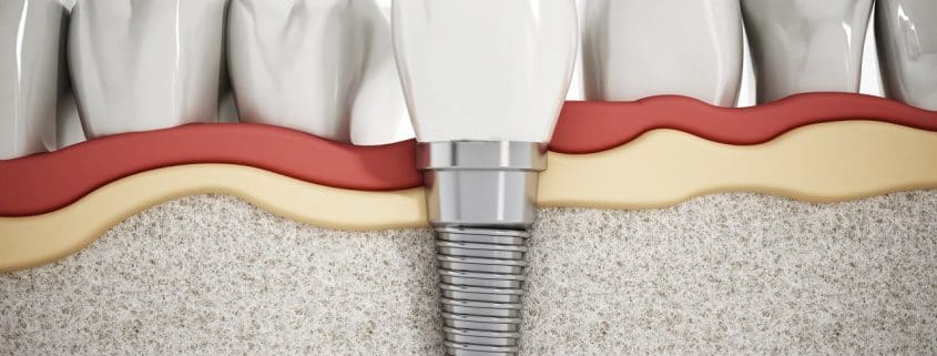 detalle del implante dental - implantes dentales