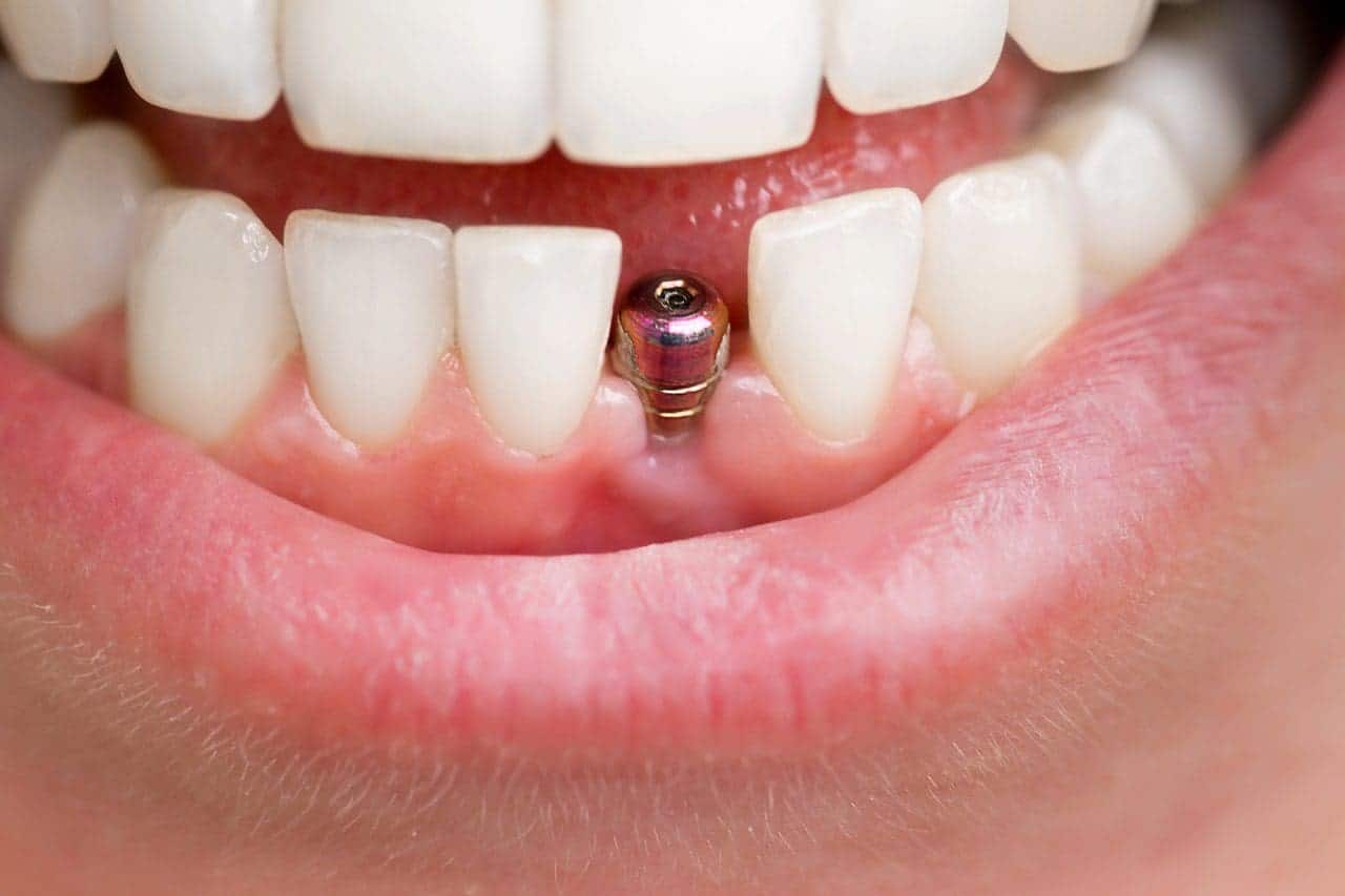 implantes dentales mujer