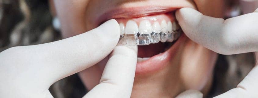 Doctor poniendo un alineador dental claro a la mujer paciente