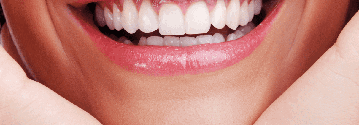 Blanqueamiento dental en Alicante 1 blanqueamiento dental en alicante