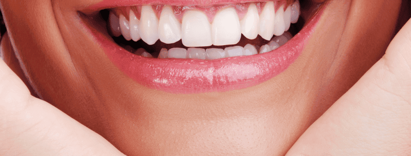 blanqueamiento dental en alicante