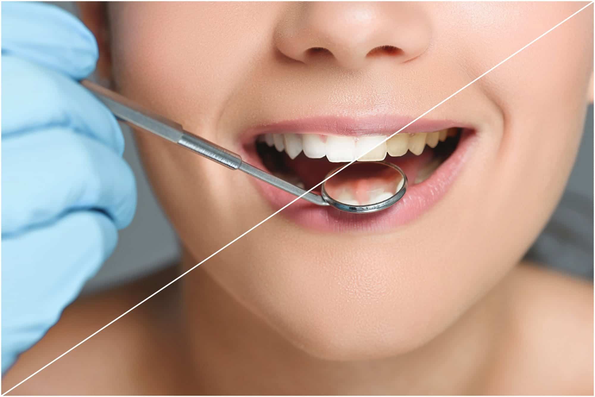 blanqueamiento dental en alicante