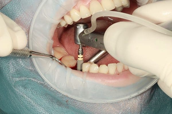 Implantes dentales: Endoóseo o Subperióstico 10 cirugia implante dental