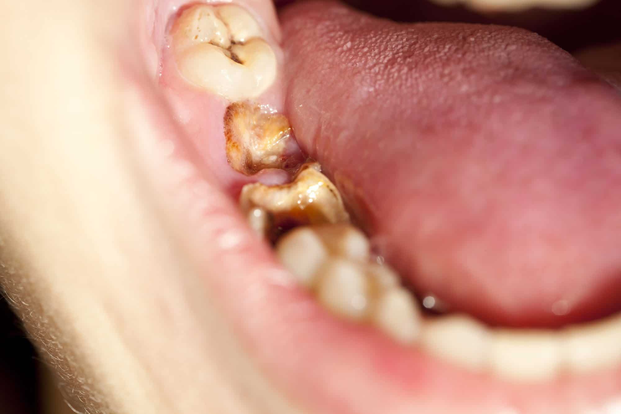 dientes estropeados - anorexia y bulimia en dientes