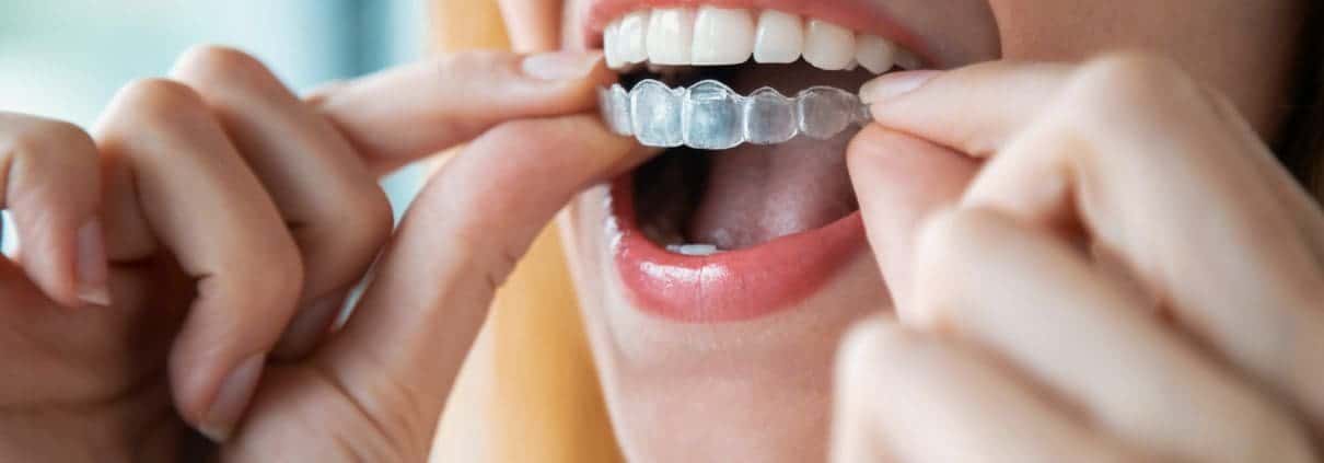 La revolución de la ortodoncia: Invisalign 1 revolucion de la ortodoncia invisalign - tendencia en ortodoncia invisalign