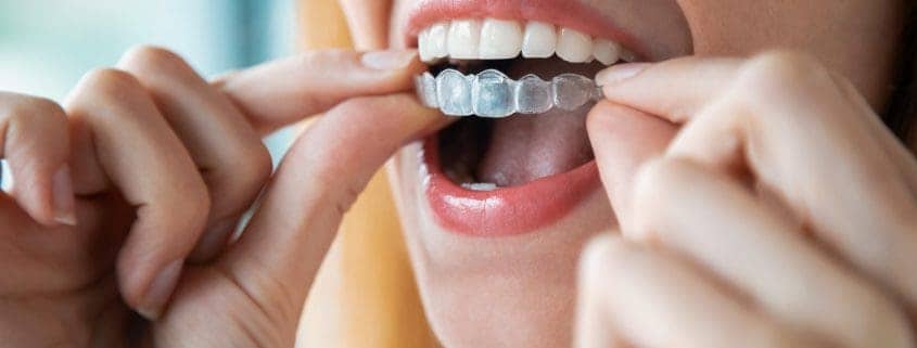 revolucion de la ortodoncia invisalign - tendencia en ortodoncia invisalign