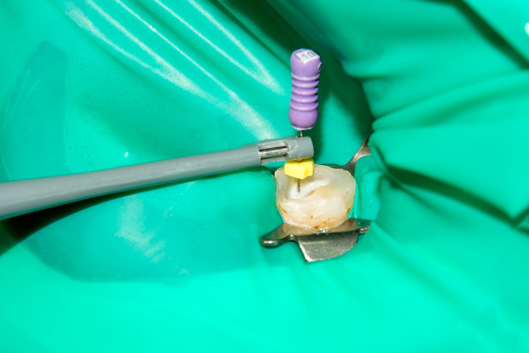 Tratamiento de las raíces del diente - que es una endodoncia