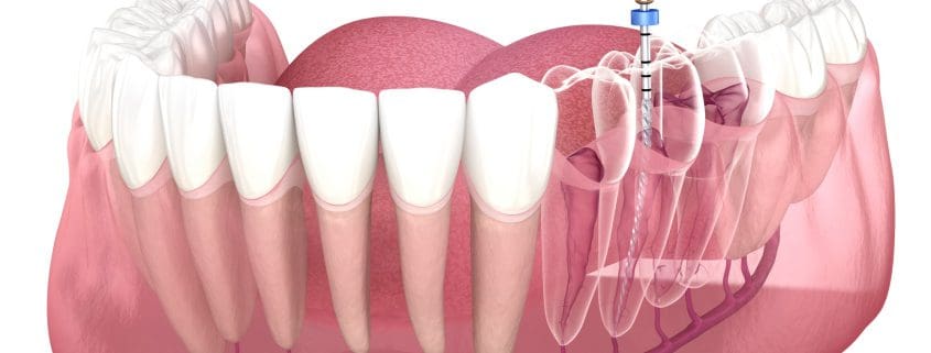 que es una endodoncia Tratamiento endodóntico del conducto radicular - endodoncia en alicante