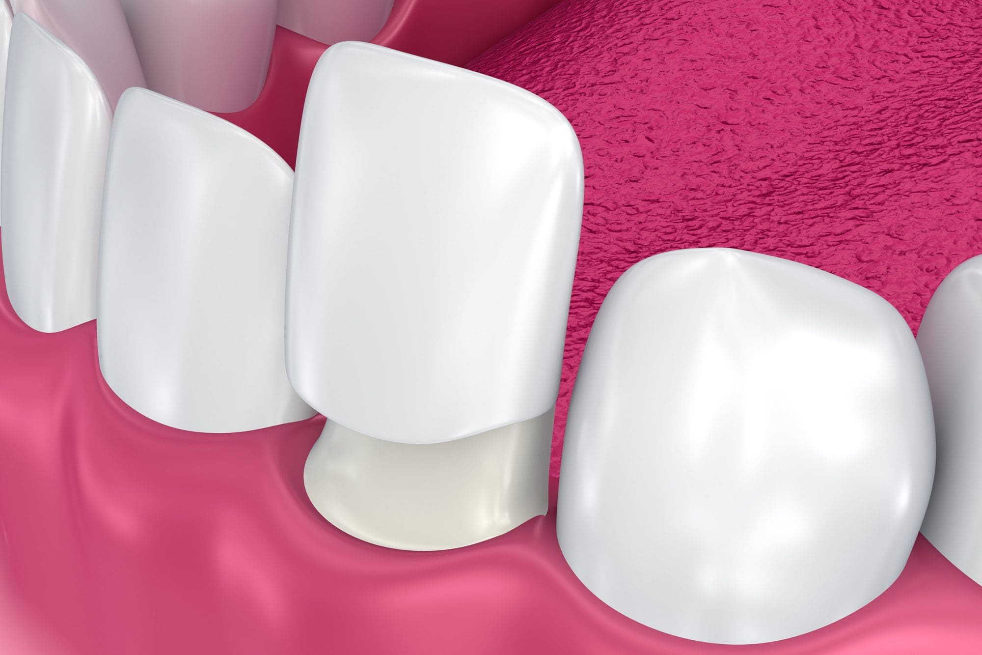 Carillas de ceramica - tratamientos de estética dental
