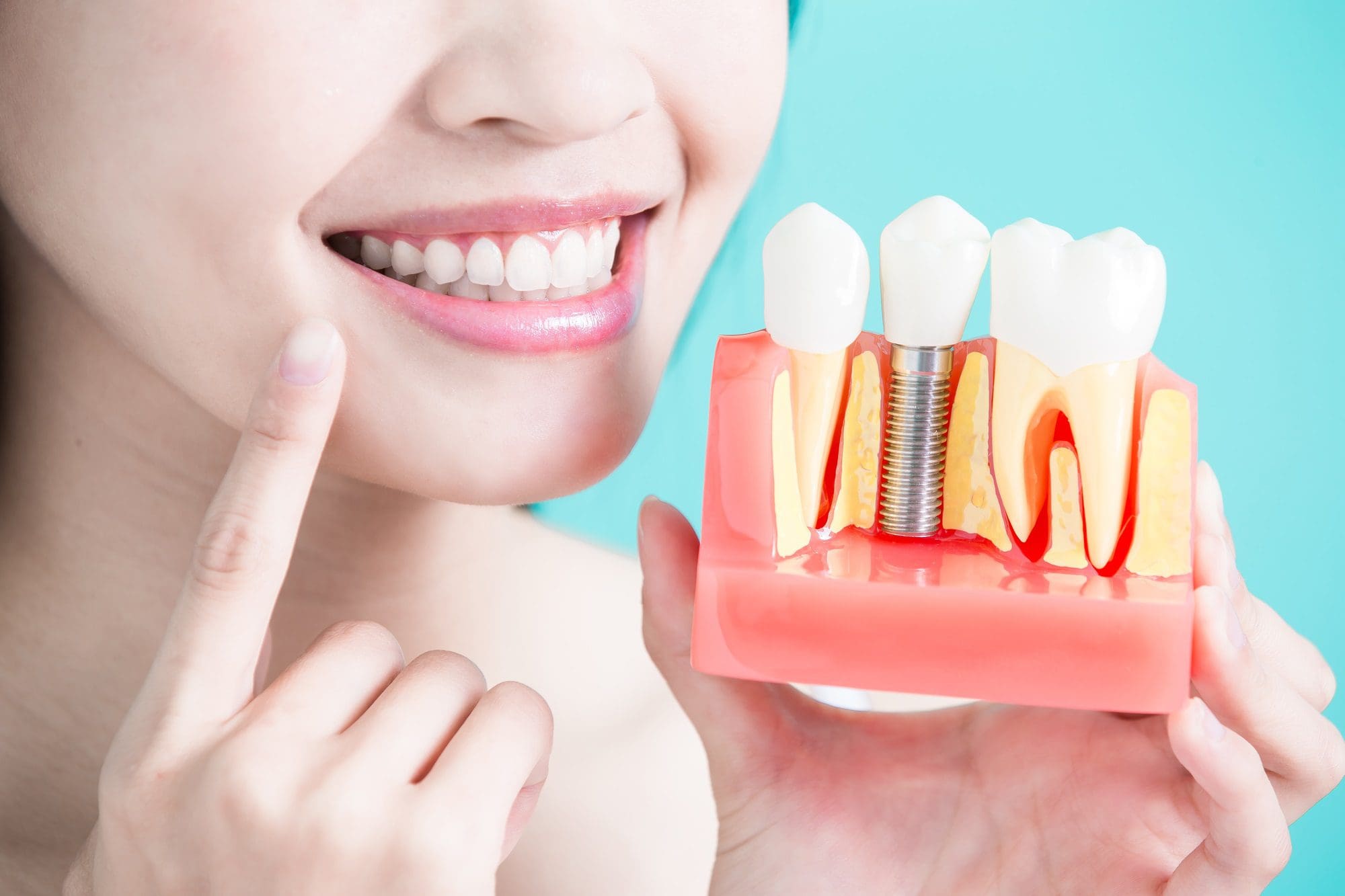 Mujer sosteniendo modelo de implante dental - tratamientos de estética dental