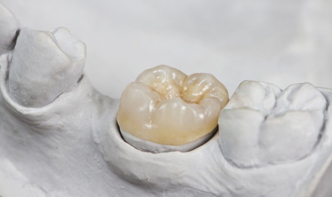 Onlay dental en un modelo de yeso - tratamientos de estética dental
