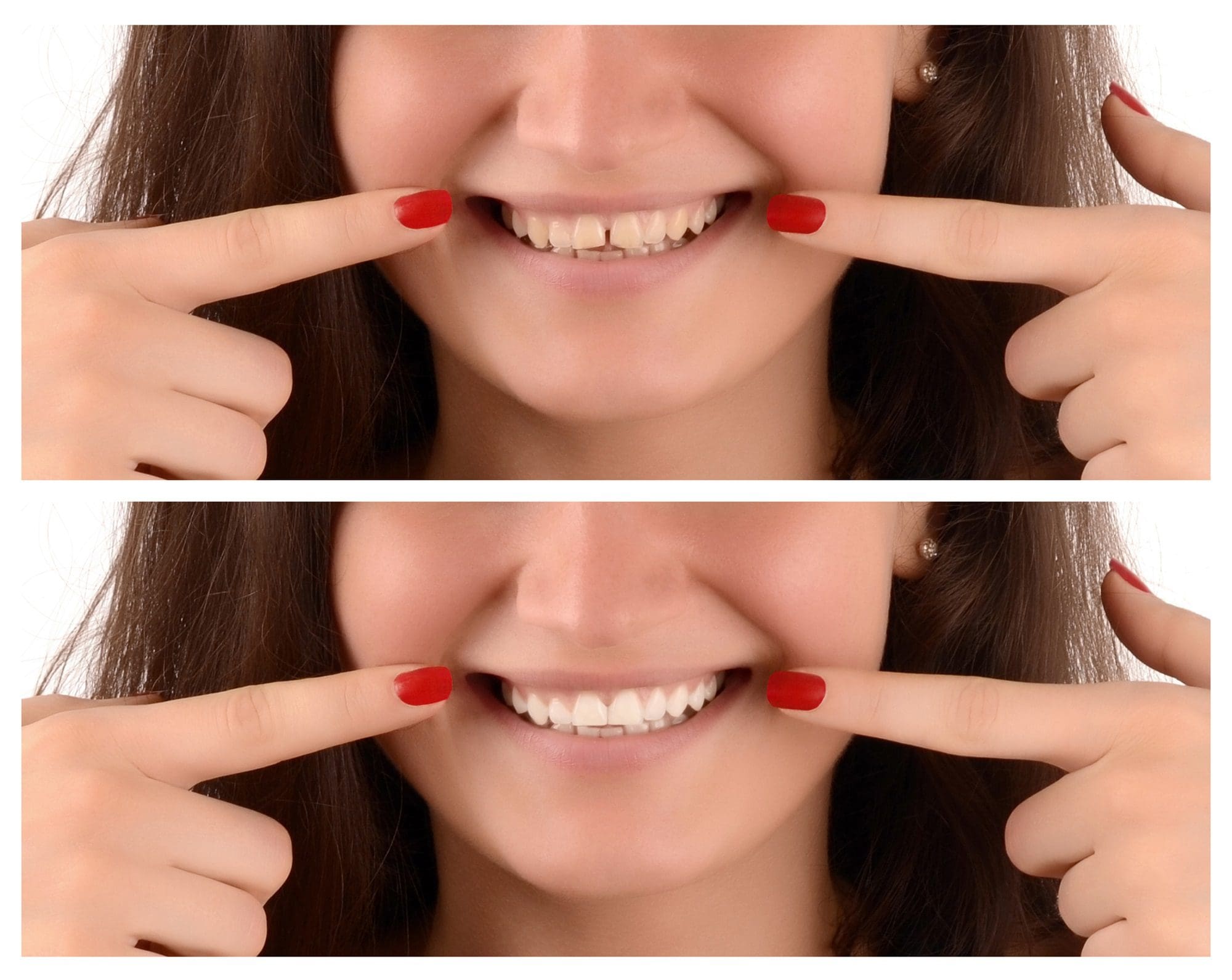 adhesion dental antes y despues - tratamientos de estética dental