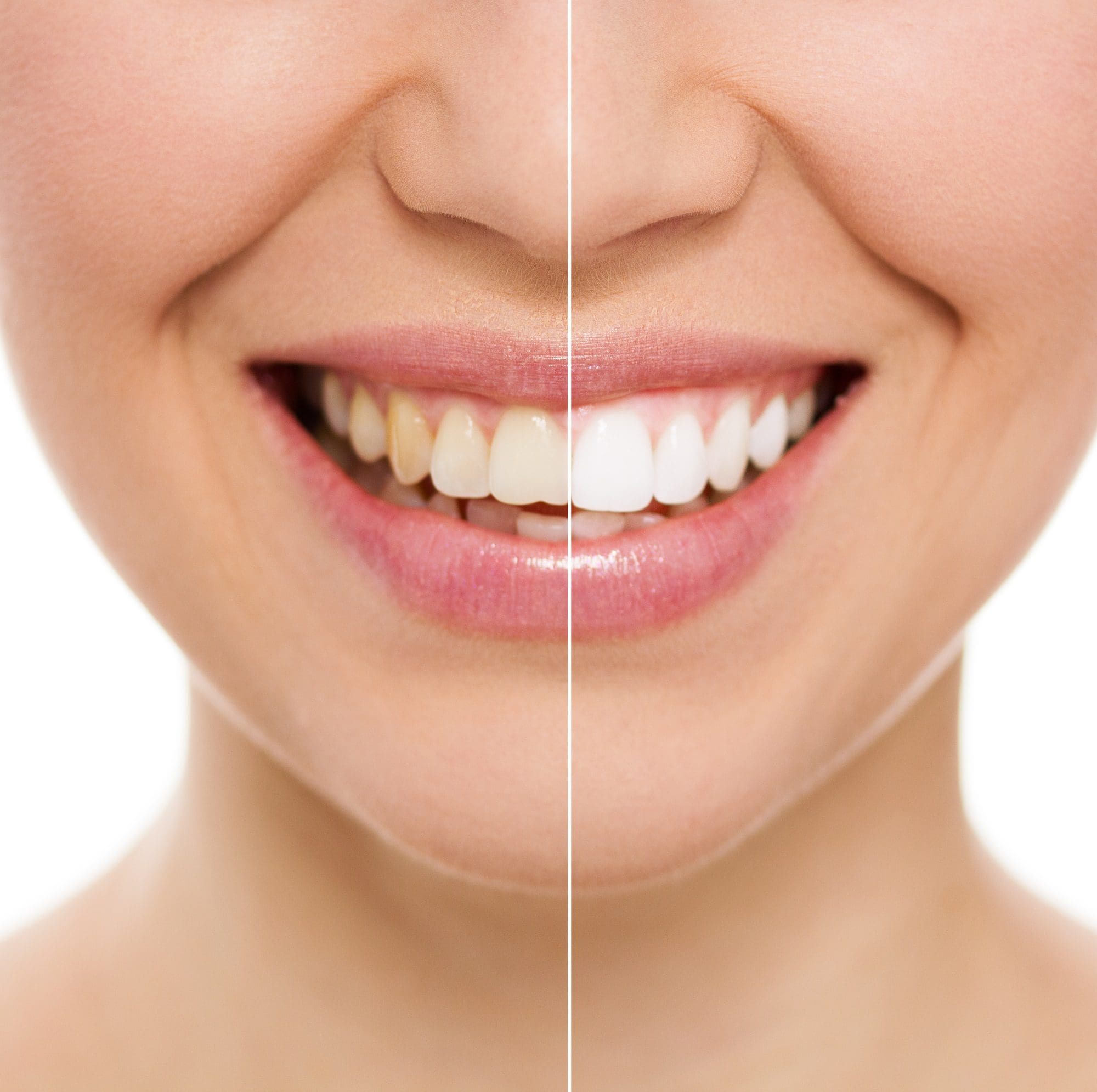 antes y después cuidado dental -tratamientos de estética dental