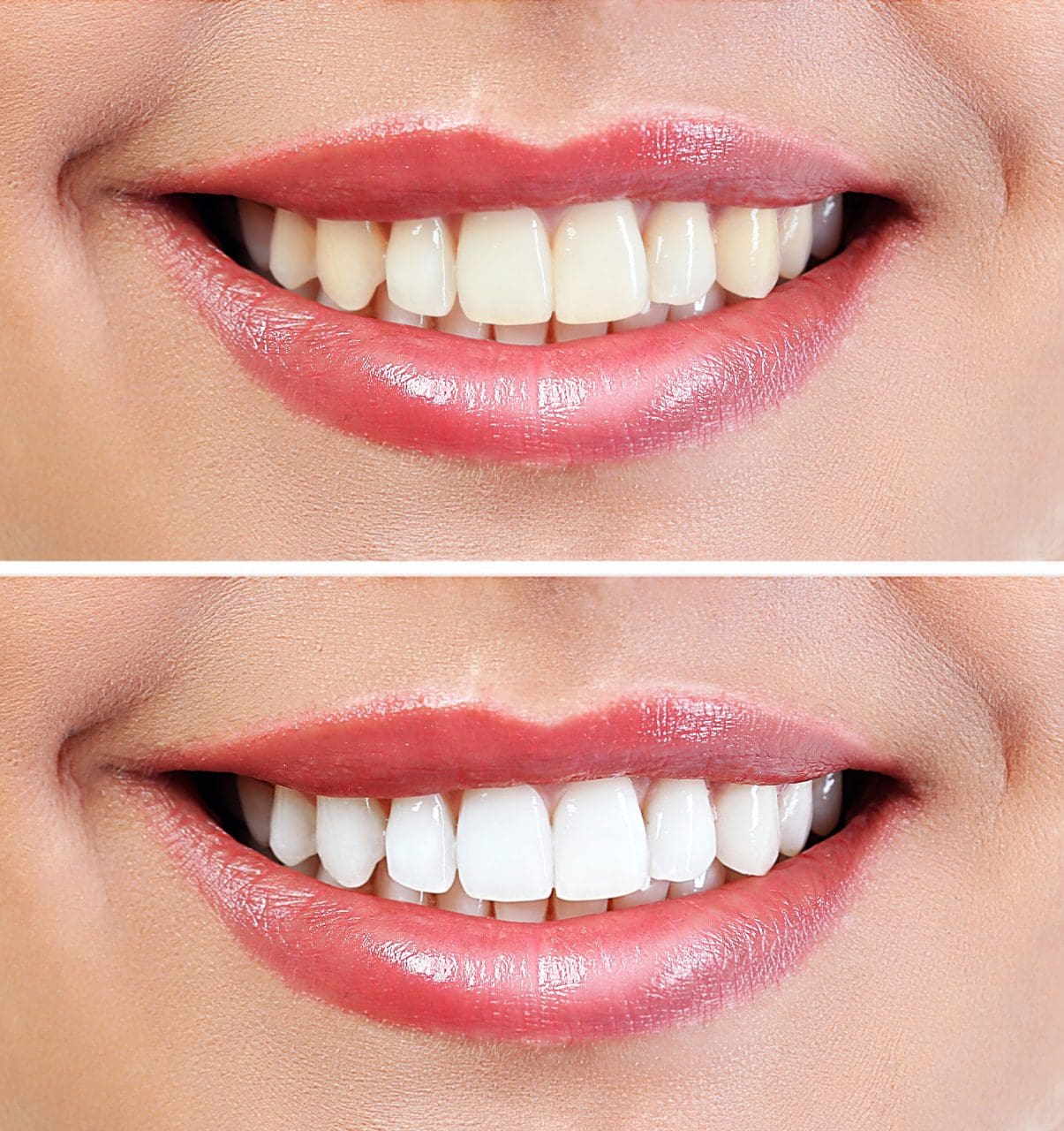 blanqueamiento dental profesional - tratamientos de estética dental