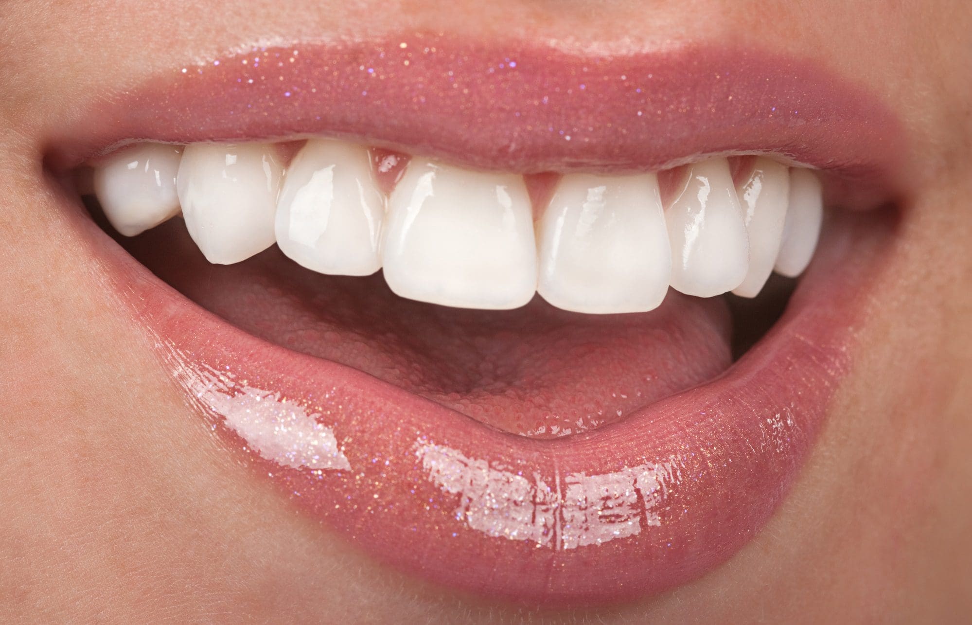 carillas de porcelana -tratamientos de estética dental