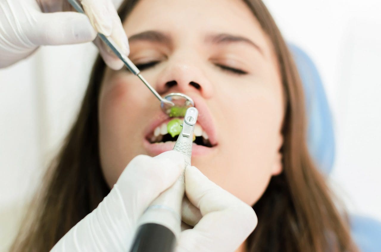 contorneado dental - tratamientos de estética dental