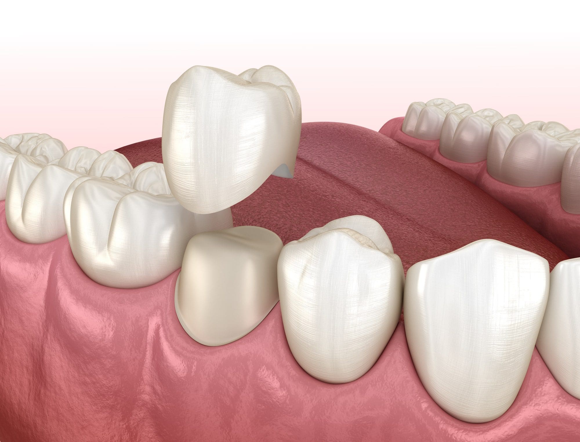 corona dental - tratamientos de estetica dental