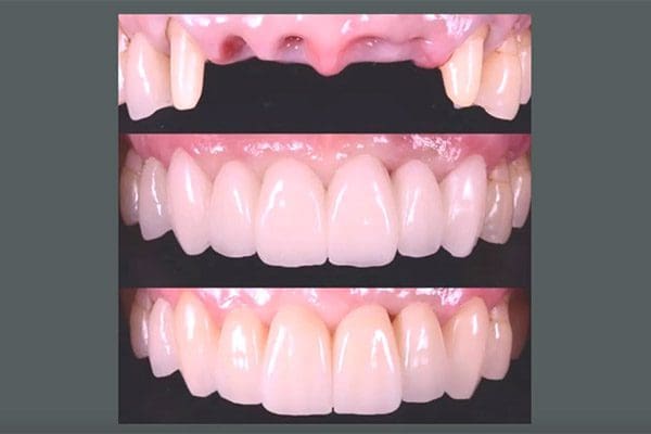 ¿Qué es la carga inmediata de implante dental? 12 carga inmediata de implante dental