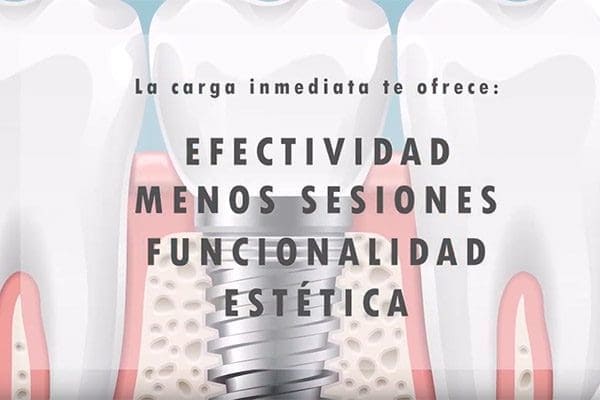 ¿Qué es la carga inmediata de implante dental? 13 carga inmediata implantes