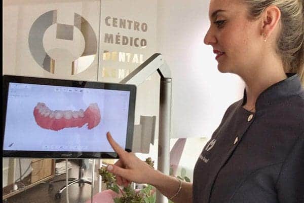 ¿Qué es la carga inmediata de implante dental? 14 carga inmediata de implante dental