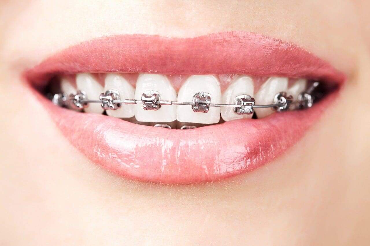 brackets con ataches - Mitos de la Ortodoncia Invisible