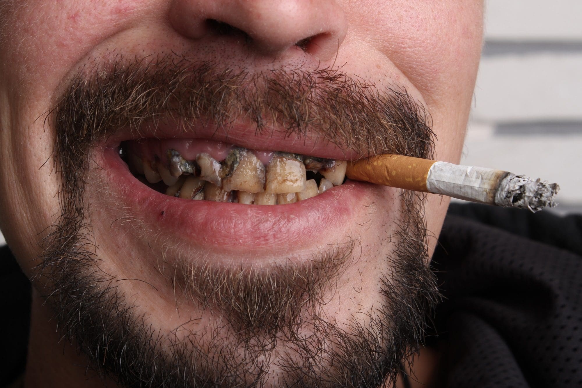 dientes fumador con enfermedad cáncer oral - problemas dentales mas comunes
