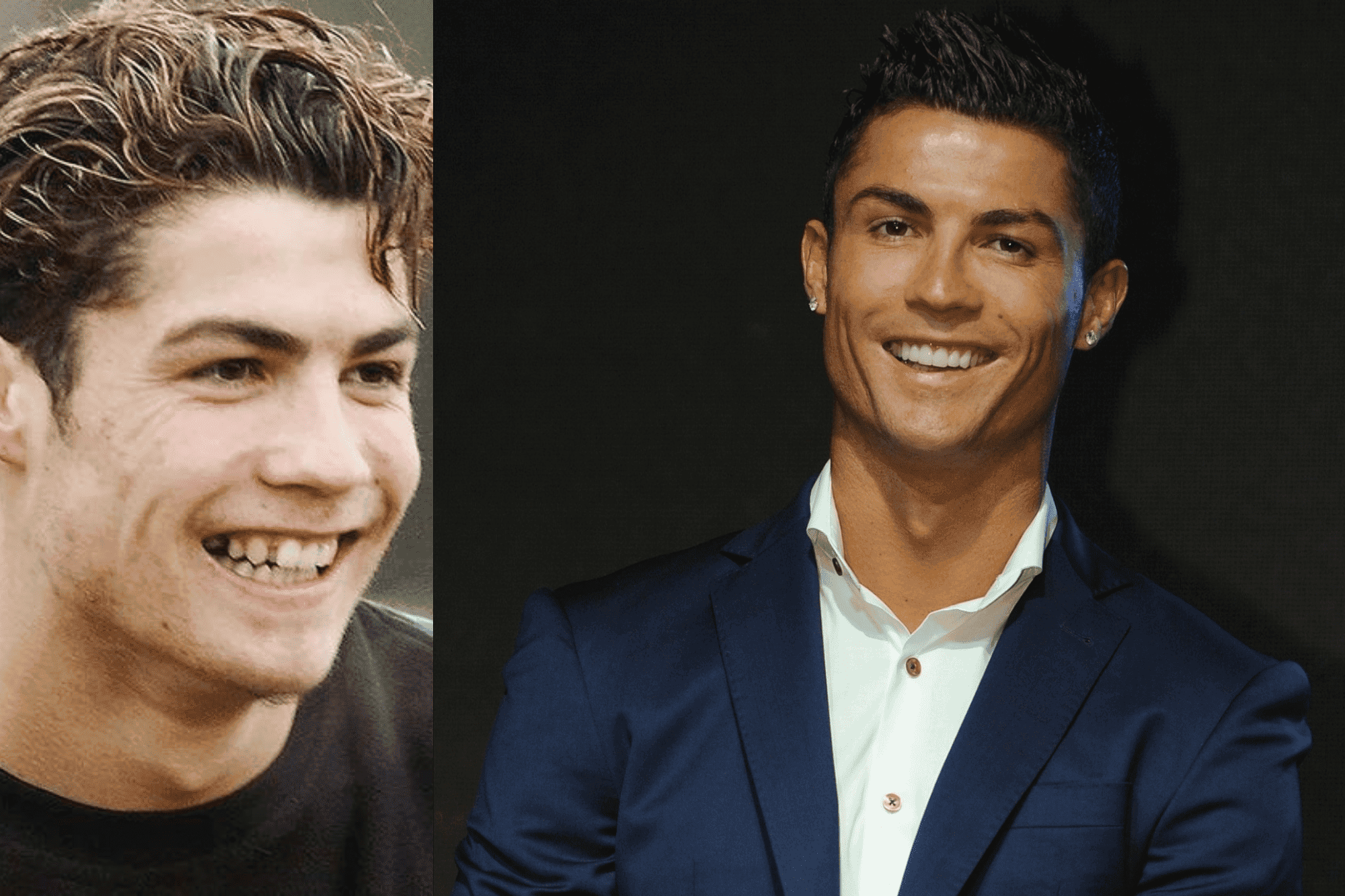 famosos con carillas Cristiano Ronaldo antes y después - famosos que usan carillas
