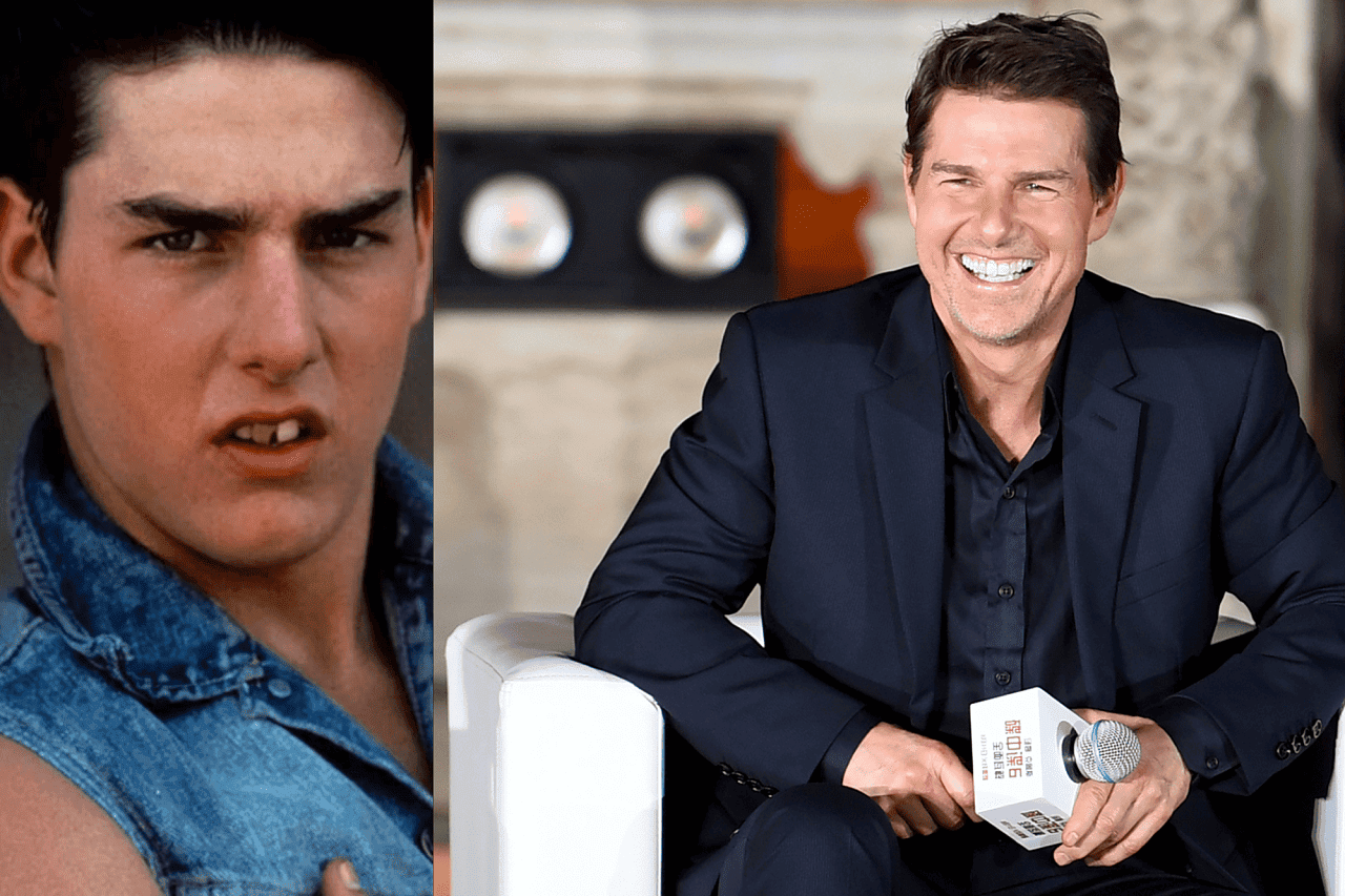 famosos con carillas Tom Cruise antes y después - famosos que usan carillas