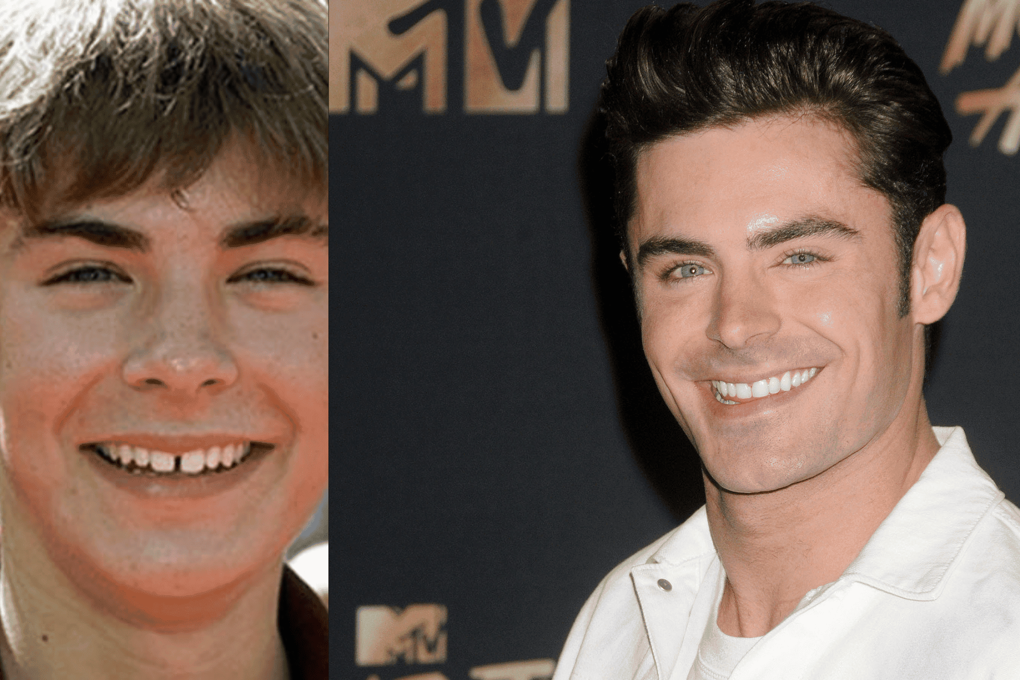 famosos con carillas Zack Efron antes y después - famosos que usan carillas