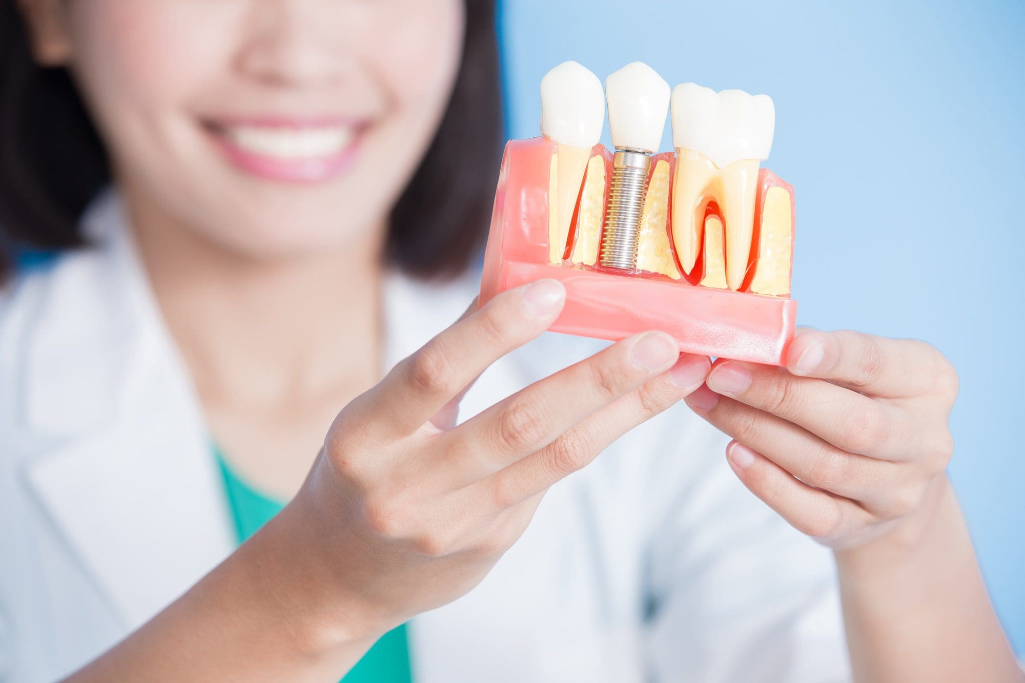 Dentista con modelo de diente de implante tornillo