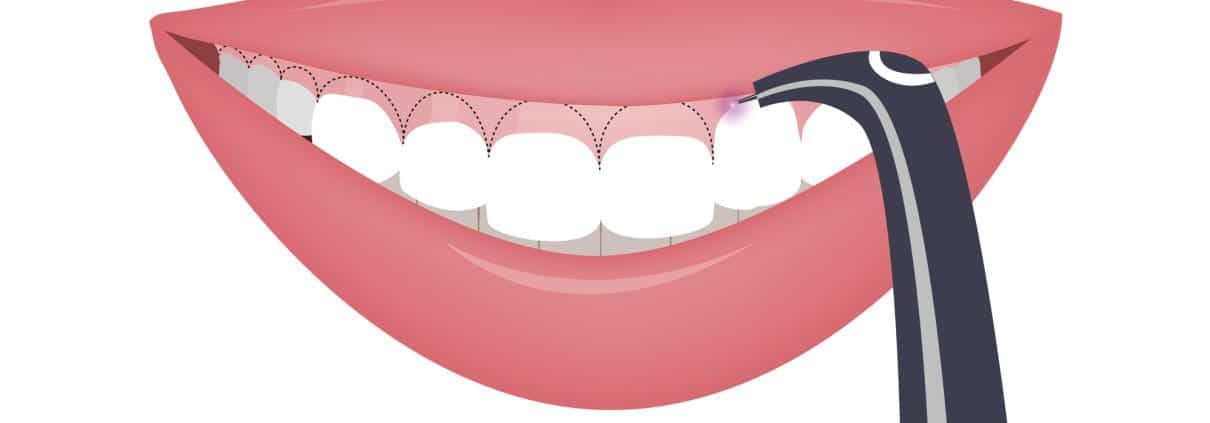sonrisa gingival portada