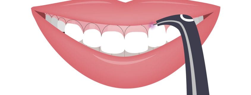 ¿Tienes sonrisa gingival? Cómo tratarla 27 sonrisa gingival portada