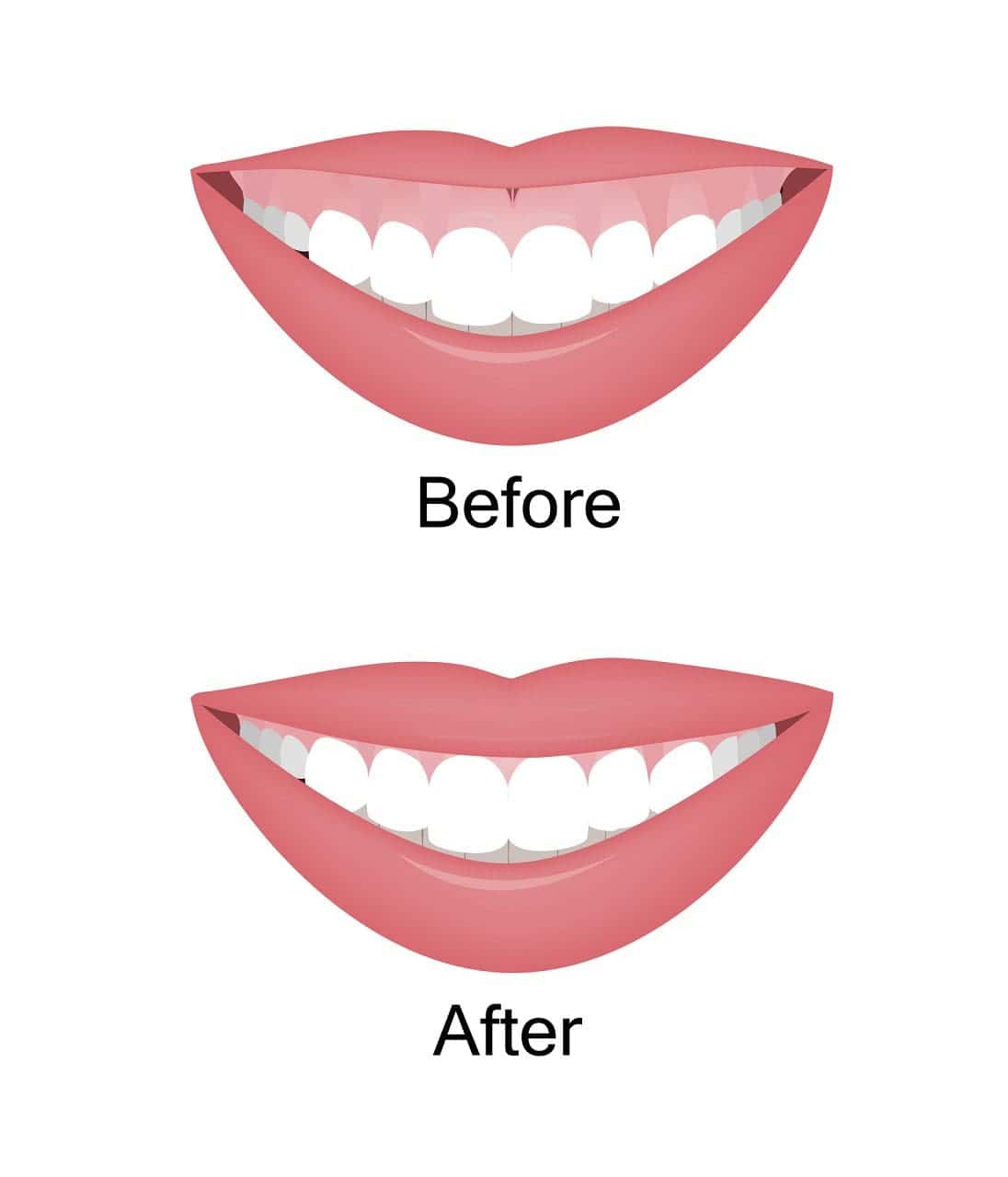 sonrisa gingival sonrisa gingival
