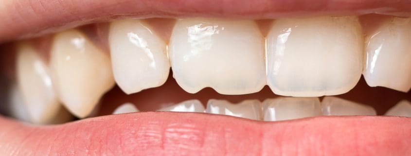 ¿Qué hacer si se astilla o se rompe un diente? 26 Que hacer si se astilla o se rompe un diente