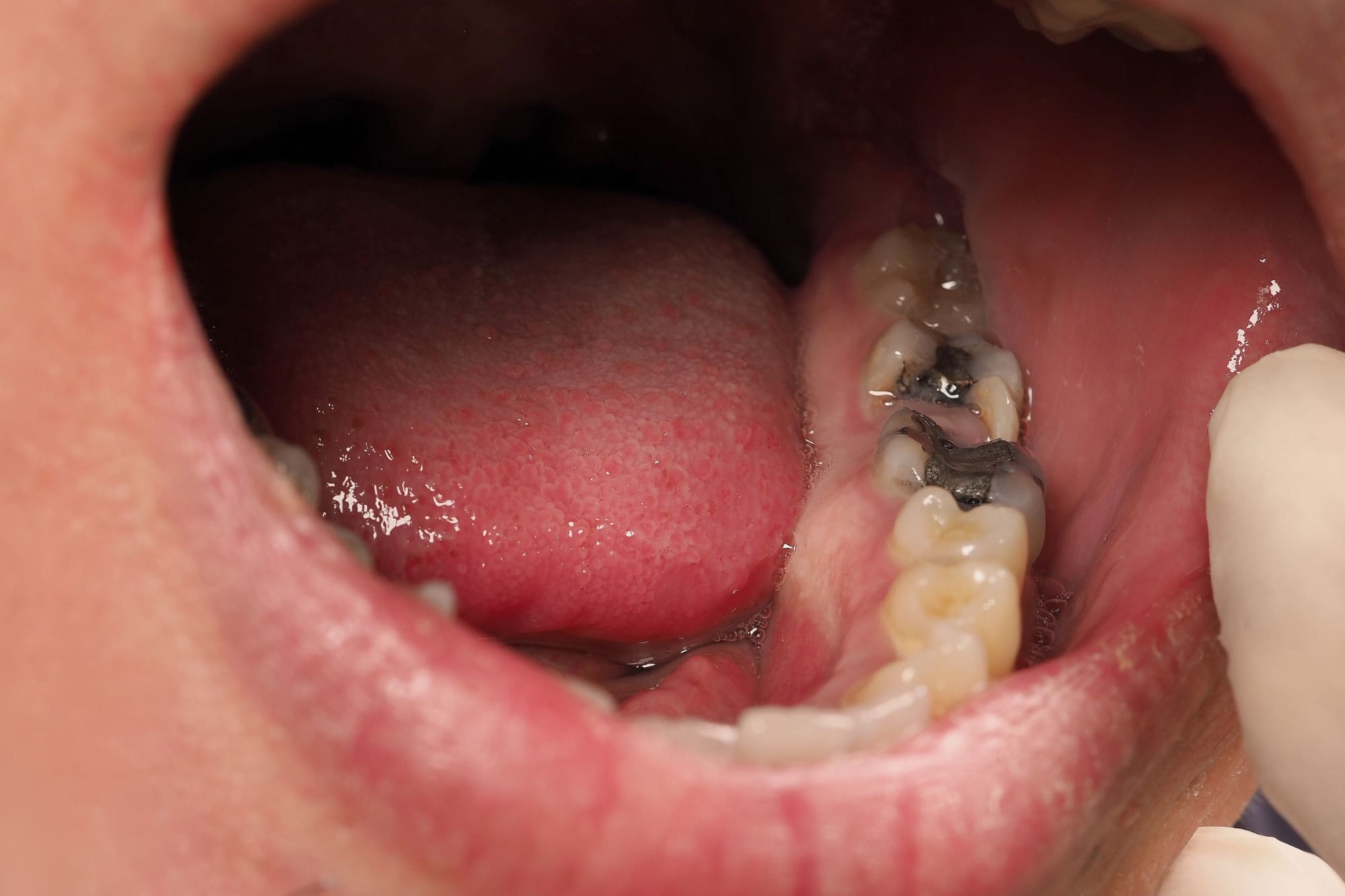 caries dental - ¿Por qué puede ponerse un diente negro?