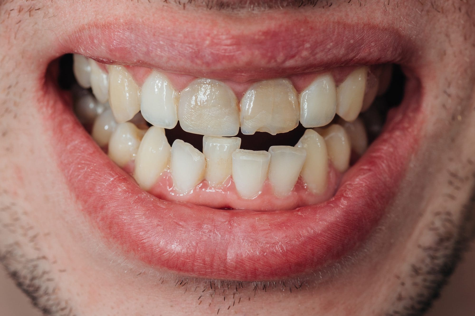 dientes torcidos y astillados - Qué hacer si se astilla o se rompe un diente