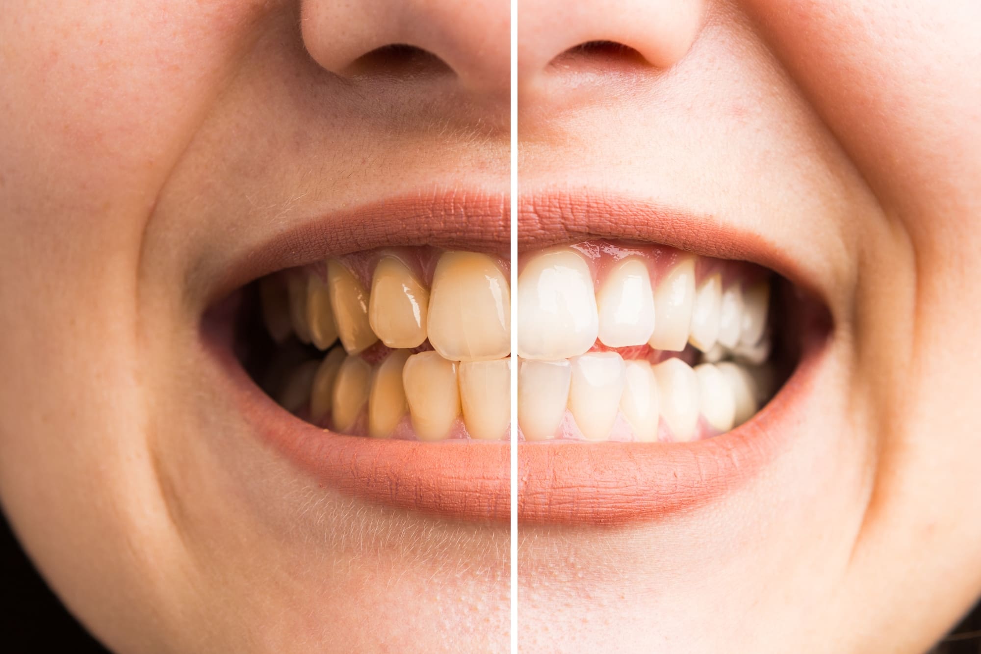 nuevo blanqueamiento dental interno - ¿Por qué puede ponerse un diente negro?