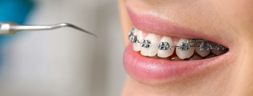 Necesito ortodoncia