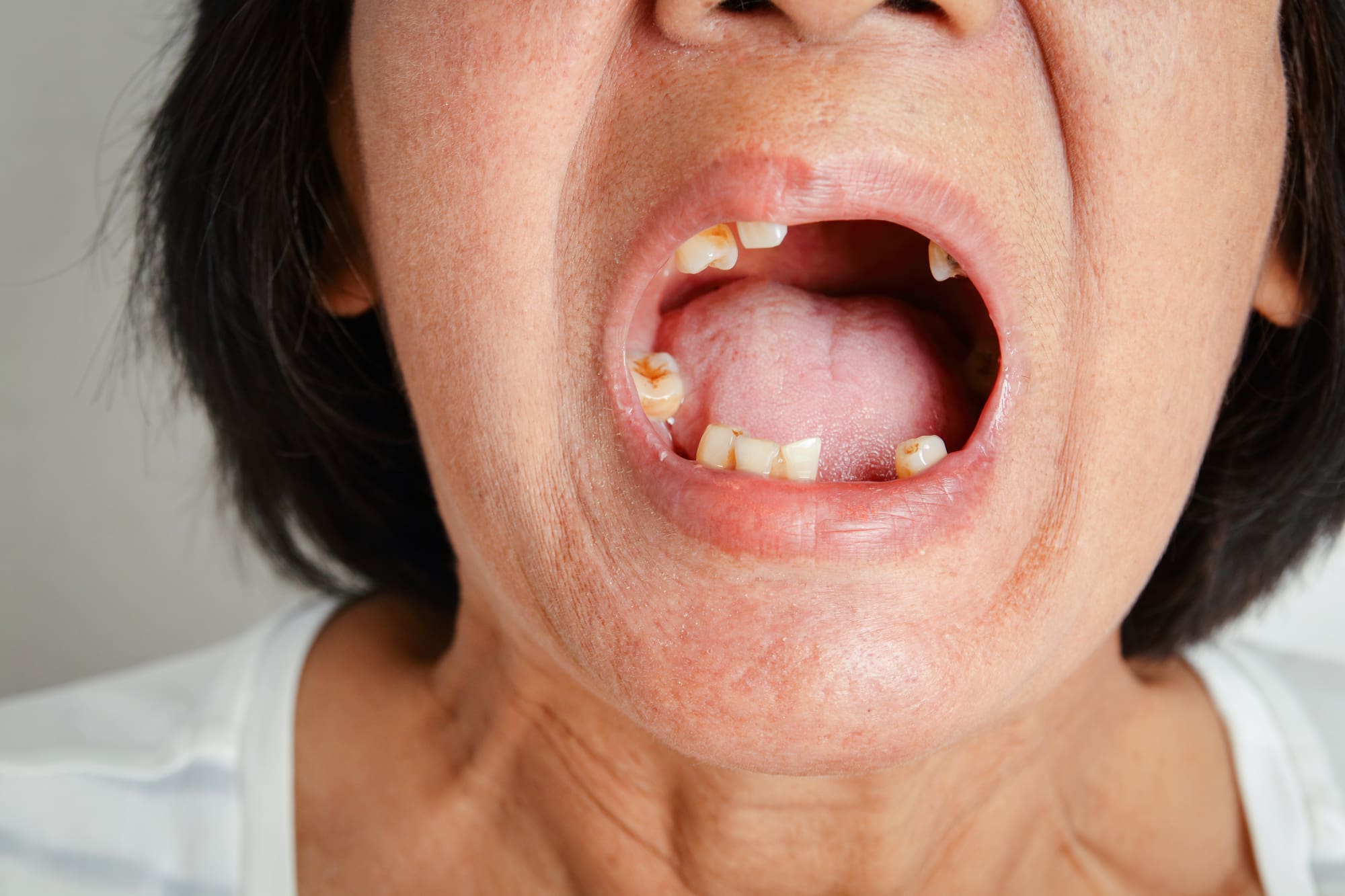 muchos dientes caídos en mujer mayor - Caída de diente